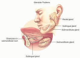 Image result for Sialolithiasis