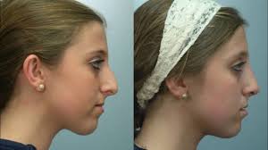 The technique itself was originally introduced by. Fireside Chats With Dr Edwin Williams What Are Spreader Grafts Youtube