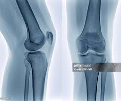 Image result for Knee XRay
