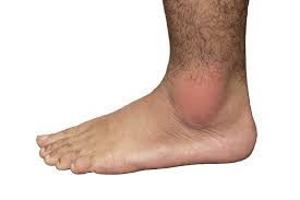 This applies to very serious diseases. Gout In The Feet Expert Guide To The Best Shoes For Gout Family Footwear Center
