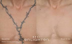 We use the industry's most effective and safest laser tattoo removal technology to remove your tattoo. Laser Tattoo Removal Before And After Dallas Fort Worth Tx