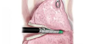 A pneumothorax can develop into a collapsed lung. Pneumothorax