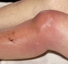 Image result for Septic Joint