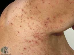 Image result for skin rash similar to scabies