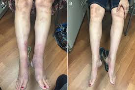 Image result for erythema nodosum