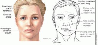 Bell's palsy is a condition in which one side of the face suffers nerve damage, causing severe this immobilization causes a droop on the affected side of the face. Bell S Palsy Symptoms Causes And Risk Factors The Aster Blog