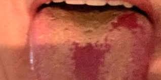 En reaksjon på medisinering er den vanligste årsaken til svarte flekker på tungen. Sannheten Om Rode Flekker Pa Tungen Sarexskin Com