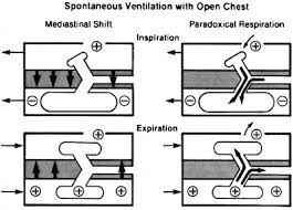 Maybe you would like to learn more about one of these? Physiology Of The Lateral Decubitus Position Open Chest And One Lung Ventilation Springerlink