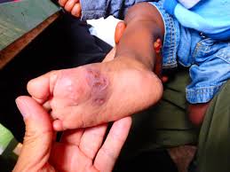 Image result for scabies human children
