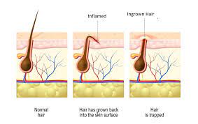 Back in march, we gave an overview of ingrowns, why they happen. Ingrown Hairs In Your Beard Here S How To Treat Them Razors Co
