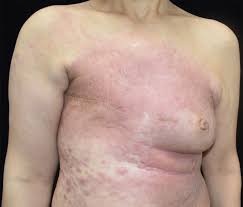 Image result for Inflammatory breast cancer