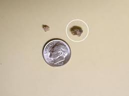 Kidney Stone Pictures Stone Pictures Kidney Stones Stone