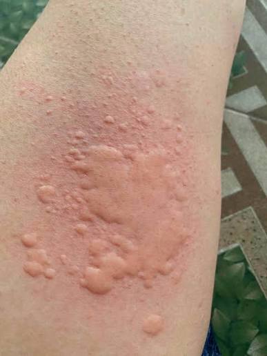 MUỐN DA HẾT NGỨA, MẨN ĐỎ: TRƯỚC HẾT PHẢI DƯỠNG KHÍ HUYẾT Nhiều người bị  ngứa da, mẩn đỏ, viêm da, mề đay cứ nghĩ bệnh chỉ nằm ở ngoài da. Ngứa