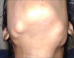 Image result for Gardner Sendromu