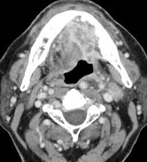Image result for spinocellular carcinoma of the oral cavity
