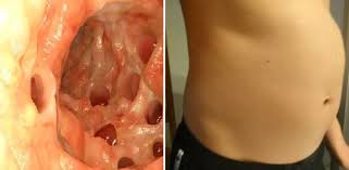 Do You Have Bloated Stomach Warning Signs You Should Never Ignore Wise Thinks