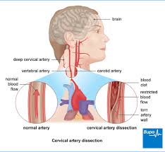 The internal carotid artery, meanwhile, is tasked with supplying the forebrain, which houses the cerebral hemispheres (the sight of language and cognition), the thalamus (essential for sensory processing and sleep), and the hypothalamus (which regulates hormones and metabolism). Cervical Artery Dissection Health Information Bupa Uk