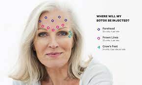 If you would like to maximize the lifespan of your botox treatment, you can follow the following tips: Botox Forehead Face Guide What To Know In Simple Illustrations