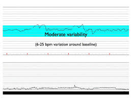 Qcom Fetal Heart Monitoring Baseline Variability