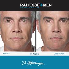 ✨RADIESSE+, lifting sin cirugía para hombres RADIESSE+ Desde hace más de  una década, el número de hombres que se han interesado por los tratamientos  estéticos ha ido incrementando año tras año. La