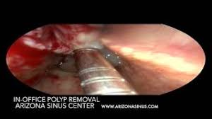 I've had this booger in my nose for at least two years, and i absolutely cannot get it out. Polypvac In Office Removal Of Nasal Polyp Removal Arizona Sinus Center Phoenix