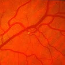 Cholesterol And The Eye Eyedolatry