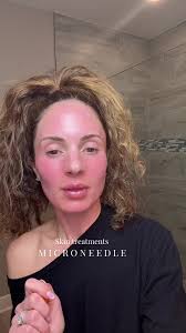 Can I Use Qure Microneedling Once Per Week