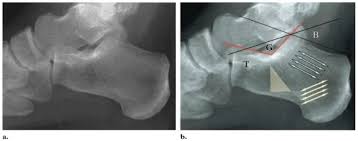 Image result for Calcaneus Compression Fracture