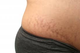 Kemunculan stretch mark pada bagian tubuh tertentu memang kadang menyebalkan dan mengganggu kepercayaan diri, entah itu bagi ibu pasca melahirkan atau mereka yang sedang menjalani diet ketat. Cara Menghilangkan Stretch Mark Cara Mengatasinya Dengan Shineskin