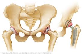 This involves removing the damaged surfaces of the bones inside the hip joint and replacing them with a metal surface. Hip Replacement Mayo Clinic