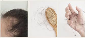 Lots of women see tufts in the drain or on the bathroom floor and freak out, but experts say that what's happening is more than likely normal. Hair Shedding What You Should Know Pcos Awareness Association