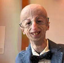 Kisah Sepak Terjang dan Ambisi Sammy Basso Meneliti Progeria