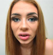 Livingston mum's lip 'turned BLACK after botched lip fillers were injected  into artery' with doctors warning she could have went BLIND