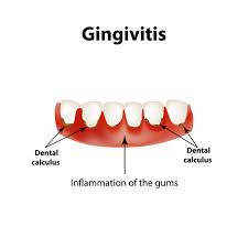 Image result for Gingivitis
