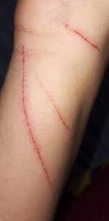 Degloving Injury Forearm Icd 10