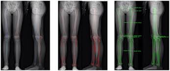 Image result for Functional Leg Length Discrepancy