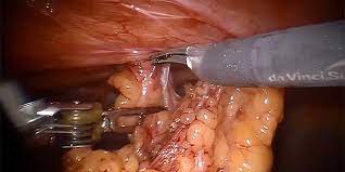 See hernia repair stock video clips. Ventral Hernia Repair In Obese Patient Population