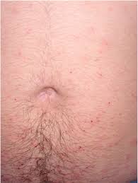 Image result for scabies effects on the human body