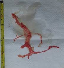 Less commonly, coughing up blood may be the result of: Patient Reportedly Coughed Up Perfect Cast Of Own Airway Shocking Doctors Evolving Science