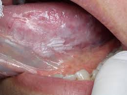 Image result for papillomavirus tongue)