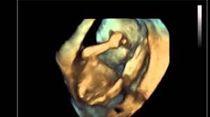 In dieser phase der frühschwangerschaft ist nur die fruchthöhle (schwarz) zu sehen, da der embryo noch zu klein ist. 4d Ultraschall 20 Ssw Videoclip Youtube