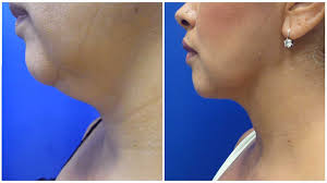 How much is chin liposuction? Chin Liposuction Chicago Chicago Liposuction By Lift Body Center