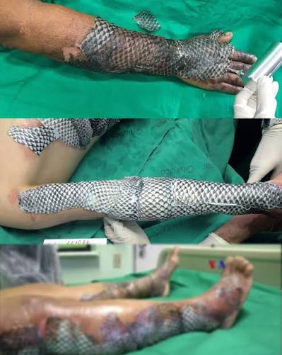 ▷ En Brasil, científicos desarrollaron un tratamiento innovador que utiliza  piel de tilapia como apósito biológico para curar quemaduras. Este tejido  natural es rico en colágeno tipo I y III, esenciales para