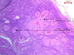 Sep 03, 2020 · epidermal inclusion cysts are the most common cutaneous cysts. Automated Identification Of Keratinization And Keratin Pearl Area From In Situ Oral Histological Images Sciencedirect