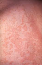 Pityriasis Versicolor Kleieflechte