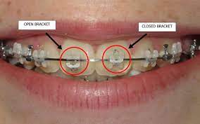 Orthodontic Problems Specialist Orthodontics Treatment Mackay Torque Orthodontics