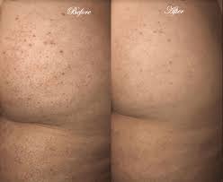 Anal Bleaching Lightening for Women Los Angeles