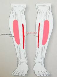 Image result for periostitis