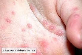 Feverheadache pierderea poftei de mâncare spălare cu blistere foarte mici pe mâini, picioare și zona de scutec, care poate fi fragedă sau dureroasă. Sindromul ManÄƒ Picior Gura Ce Este È™i Principalele Simptome Boli InfecÈ›ioase Ro Odysseedubienetre Be