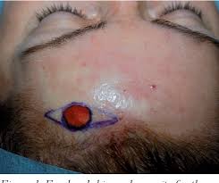 The majority of skin cancers of the head and neck are nmscs. Pdf Surgical Treatment Of Non Melanoma Skin Cancer Of The Head And Neck Expanding Reconstructive Options Semantic Scholar